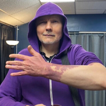 billy-corgan-opens-up-about-the-birthmarks-he’d-tried-to-hide-his-entire-life